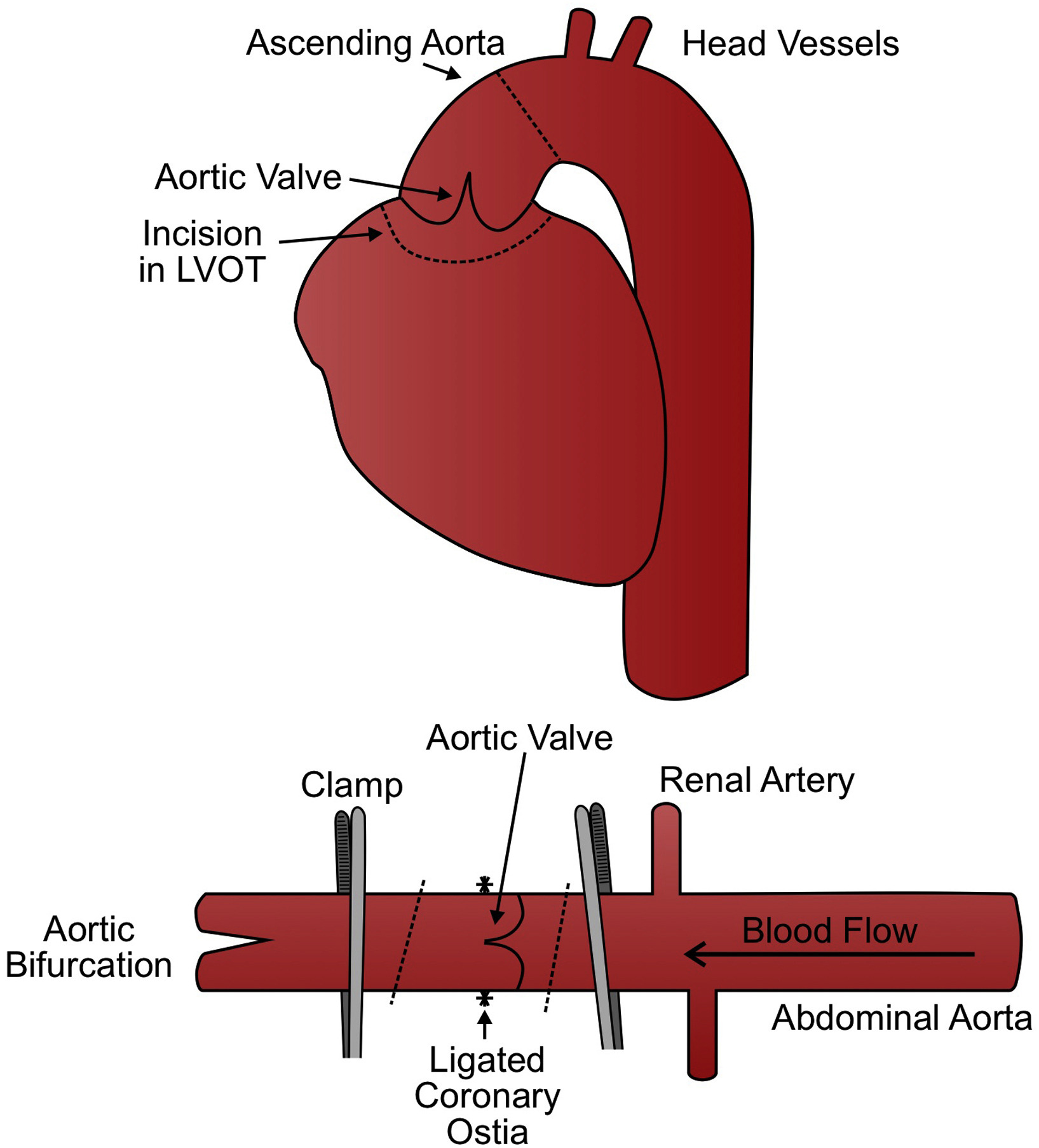 Anticoagulation Machine, aortic valve replacement, Aortic valve stenosis, artificial heart valve, benefits of self testing, bioprosthetic valve replacement, Blood Clot, cusps (tricuspid aortic valve), embolism, heart bypass, Heart failure, Heart Valve Disease, heart valve replacement, home inr, home inr testing, inr machine, inr self testing, inr test meters at home, leaky heart valve, Mechanical Heart Valve, mitral incompetence, mitral insufficiency, Mitral valve regurgitation, On-X Aortic Valve, Patient Self Testing, prosthetic heart valves, pt inr cpt code, pt inr home monitoring system, pt inr machine, pt inr test meter, PT/INR Patient Self Testing, Stroke, warfarin inr test meters