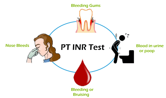 Anticoagulation Machine, aortic valve replacement, Aortic valve stenosis, artificial heart valve, benefits of self testing, bioprosthetic valve replacement, cusps (tricuspid aortic valve), embolism, heart bypass, Heart failure, Heart Valve Disease, heart valve replacement, home inr, home inr testing, inr machine, inr self testing, inr test meters, inr test meters at home, leaky heart valve, Mechanical Heart Valve, mitral incompetence, mitral insufficiency, Mitral valve regurgitation, On-X Aortic Valve, Patient Self Testing, prosthetic heart valves, pt inr cpt code, pt inr home monitoring system, pt inr machine, pt inr test meter, PT/INR Patient Self Testing, Stroke, warfarin

