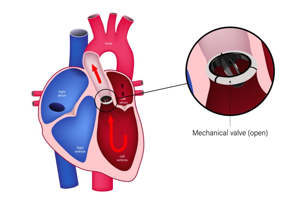 Anticoagulation Machine, aortic valve replacement, Aortic valve stenosis, artificial heart valve, benefits of self testing, bioprosthetic valve replacement, cusps (tricuspid aortic valve), embolism, heart bypass, Heart failure, Heart Valve Disease, heart valve replacement, home inr, home inr testing, inr machine, inr self testing, inr test meters, inr test meters at home, leaky heart valve, Mechanical Heart Valve, mitral incompetence, mitral insufficiency, Mitral valve regurgitation, On-X Aortic Valve, Patient Self Testing, prosthetic heart valves, pt inr cpt code, pt inr home monitoring system, pt inr machine, pt inr test meter, PT/INR Patient Self Testing, Stroke, warfarin
